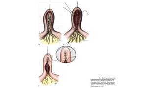 IBD PRESENTATION INCLUDING CROHNS AND ULCERATIVE COLITIS.pptx