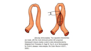 IBD PRESENTATION INCLUDING CROHNS AND ULCERATIVE COLITIS.pptx