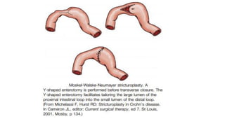 IBD PRESENTATION INCLUDING CROHNS AND ULCERATIVE COLITIS.pptx