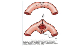 IBD PRESENTATION INCLUDING CROHNS AND ULCERATIVE COLITIS.pptx