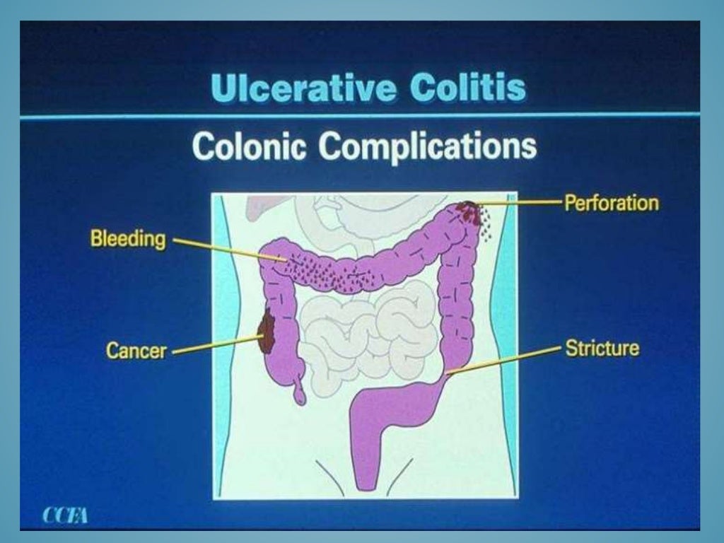 Inflammatory Bowel Disease In Pediatrics