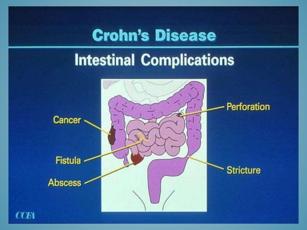 Inflammatory Bowel Disease In Pediatrics