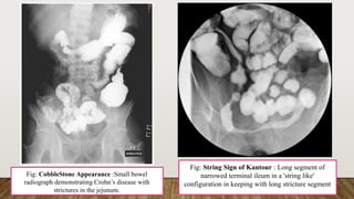 Small Intestine String. Sign Inflammatory Bowel Disease | PPTX