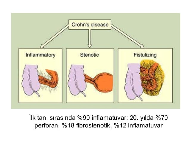 Fibrostenotik ile ilgili gÃ¶rsel sonucu