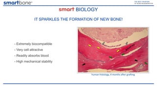 Smartbone Wedge SmartBone: the innovative bone substitute for oral surgery and ...