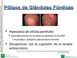 AgenciaPúblicaEmpresarialSanitariaHospitaldePoniente
Pólipos de Glándulas FúndicasPólipos de Glándulas Fúndicas
 Hiperplasia de células parietales
 Esporádicamente se ha descrito displasia en los PGF
 Asociado a poliposis adenomatosa familiar
 Desaparecen con la supresión de la terapia
antisecretora
Thomson Alan, et. al. Safety of the long term use of proton pump inhibitors, World Journal of Gastroenteology,
2010;16(19):2323-2330
 