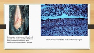 Reddening of vulval mucosa with dark red
punctate foci; vesicles, pustules which soon
form a membrane and peeling of the
membrane develop ulceration & necrosis
Intranuclear inclusion bodies inside epithelium of vagina
 