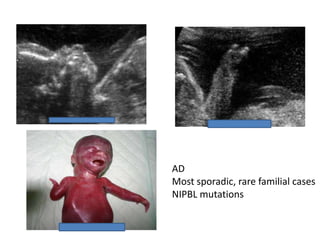 AD
Most sporadic, rare familial cases
NIPBL mutations
 