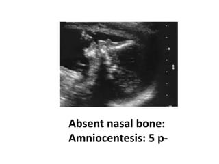 Absent nasal bone:
Amniocentesis: 5 p-
 