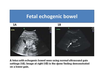 Fetal echogenic bowel
 