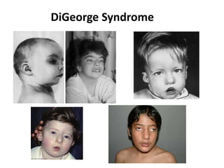 DiGeorge Syndrome
 