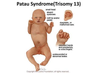 Patau Syndrome(Trisomy 13)
 
