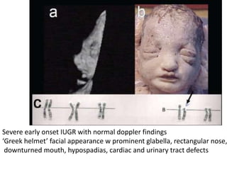 Severe early onset IUGR with normal doppler findings
‘Greek helmet’ facial appearance w prominent glabella, rectangular nose,
downturned mouth, hypospadias, cardiac and urinary tract defects
 