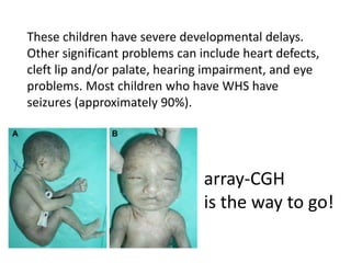 These children have severe developmental delays.
Other significant problems can include heart defects,
cleft lip and/or palate, hearing impairment, and eye
problems. Most children who have WHS have
seizures (approximately 90%).
array-CGH
is the way to go!
 