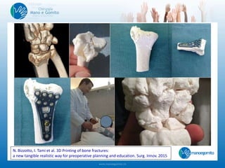 N. Bizzotto, I. Tami et al. 3D Printing of bone fractures:
a new tangible realistic way for preoperative planning and education. Surg. Innov. 2015
 