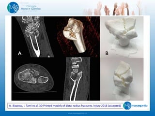 N. Bizzotto, I. Tami et al. 3D Printed models of distal radius fractures. Injury 2016 (accepted)
 