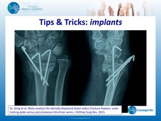 Tips & Tricks: implants
SL. Zong et al. Meta-analysis for dorsally displaced distal radius fracture fixation: volar
locking plate versus percutaneous Kirschner wires. J Orthop Surg Res. 2015
 