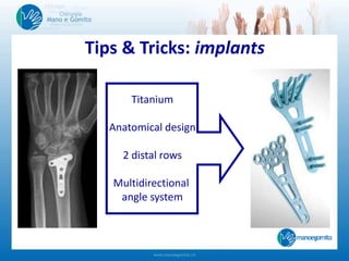 Tips & Tricks: implants
Titanium
Anatomical design
2 distal rows
Multidirectional
angle system
 