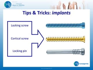 Tips & Tricks: implants
Locking screw
Cortical screw
Locking pin
 