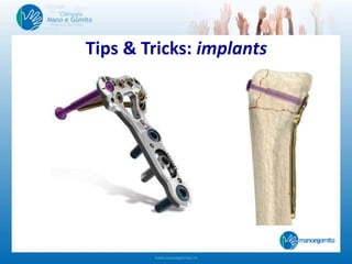 Tips & Tricks: implants
 