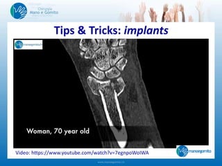 Tips & Tricks: implants
Video: https://www.youtube.com/watch?v=7egnpoWoIWA
 