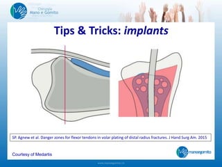 Tips & Tricks: implants
Courtesy of Medartis
SP. Agnew et al. Danger zones for flexor tendons in volar plating of distal radius fractures. J Hand Surg Am. 2015
 