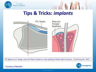 Tips & Tricks: implants
Courtesy of Medartis
SP. Agnew et al. Danger zones for flexor tendons in volar plating of distal radius fractures. J Hand Surg Am. 2015
 