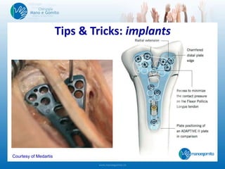 Tips & Tricks: implants
Courtesy of Medartis
 