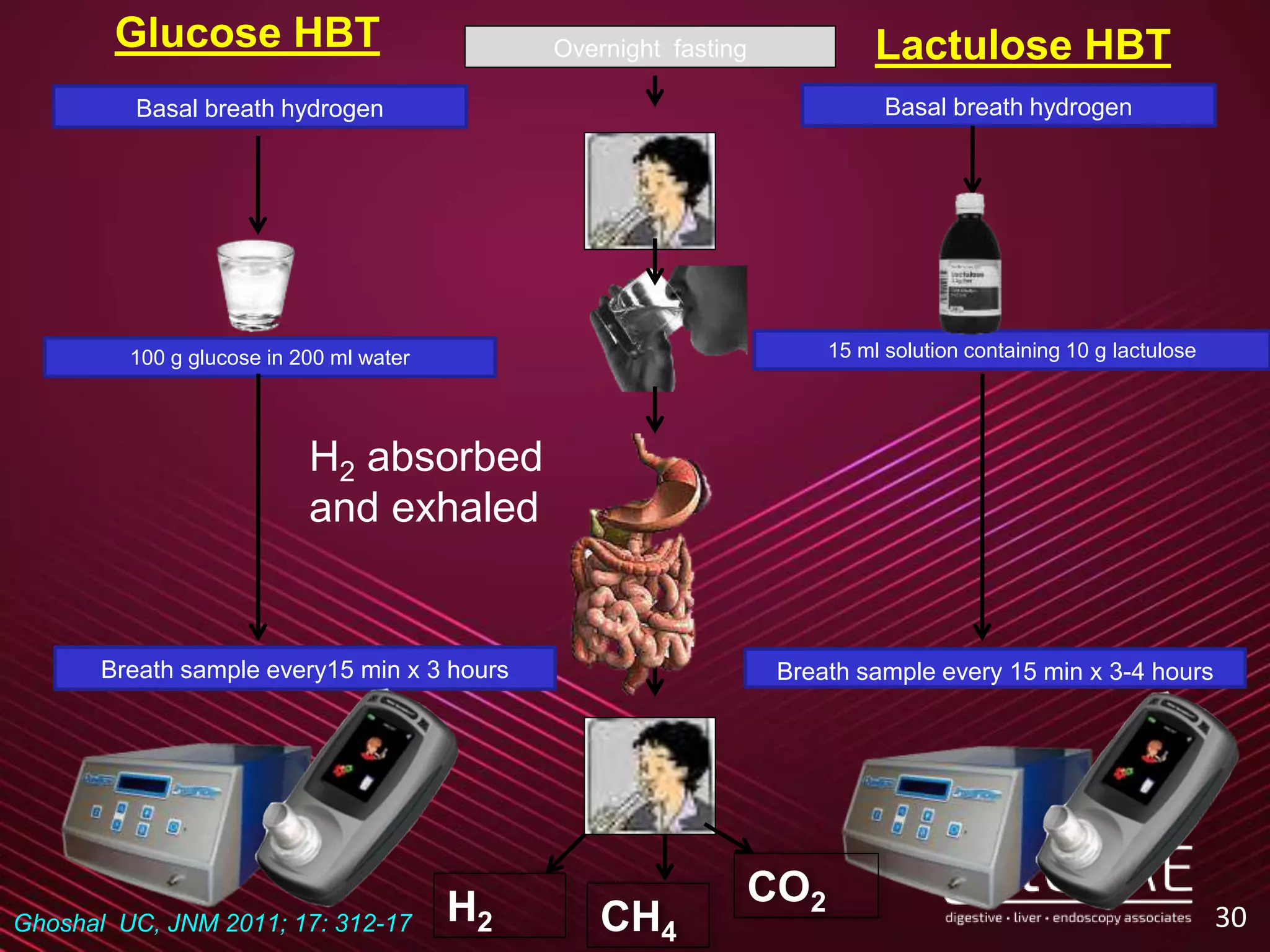 30
Glucose HBT Lactulose HBTOvernight fasting
Breath sample every15 min x 3 hours Breath sample every 15 min x 3-4 hours
100 g glucose in 200 ml water 15 ml solution containing 10 g lactulose
Basal breath hydrogen Basal breath hydrogen
H2 CH4
CO2
H2 absorbed
and exhaled
Ghoshal UC, JNM 2011; 17: 312-17
 