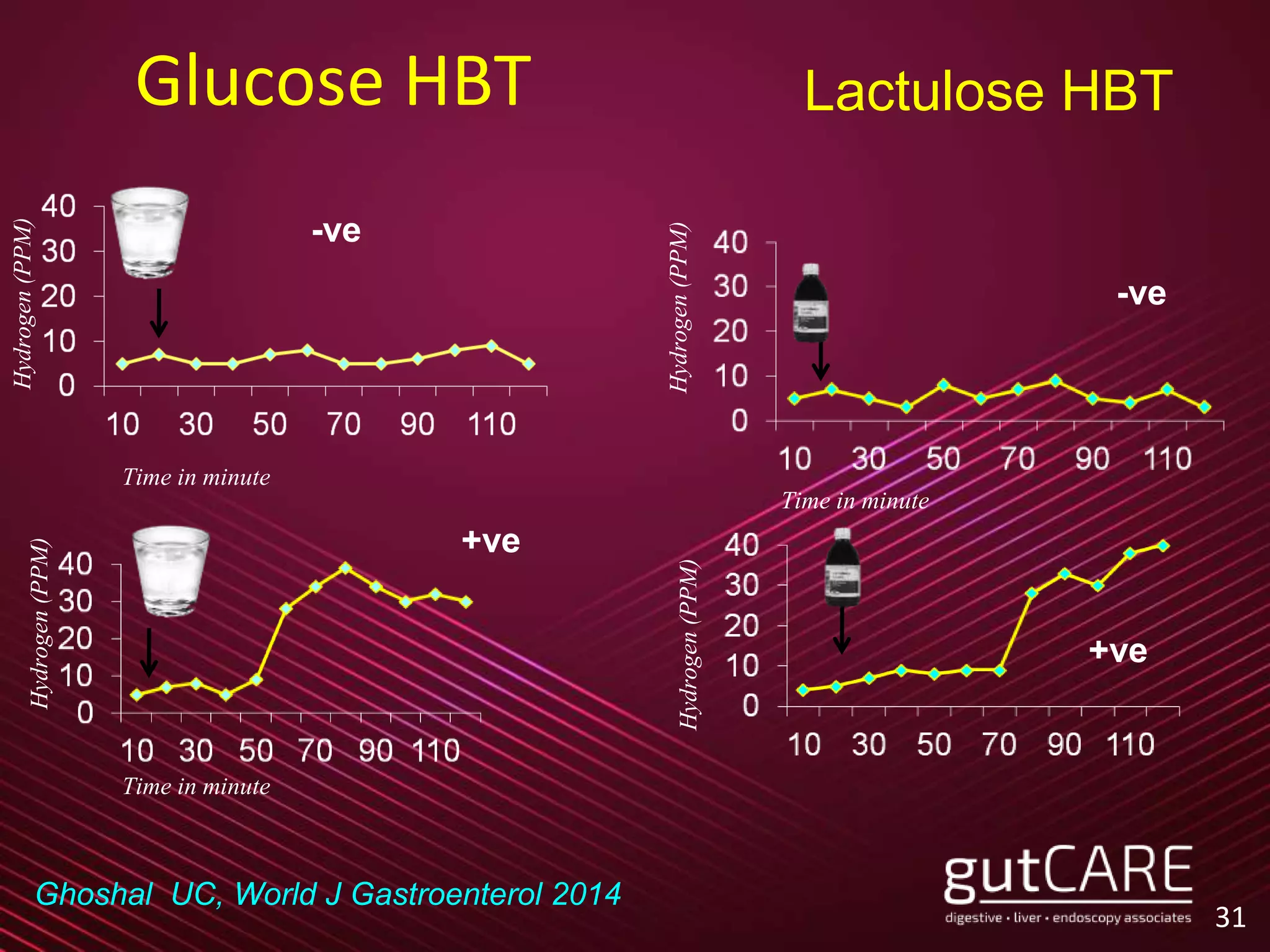 31
Glucose HBT
Hydrogen(PPM)
Hydrogen(PPM)
Hydrogen(PPM)Hydrogen(PPM)
Time in minute
Time in minute
Time in minute
Lactulose HBT
Ghoshal UC, World J Gastroenterol 2014
-ve
+ve
+ve
-ve
 