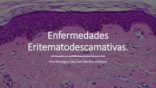 Enfermedades
Eritematodescamativas.
Montenegro Sanchez Bertha Evelyne
 
