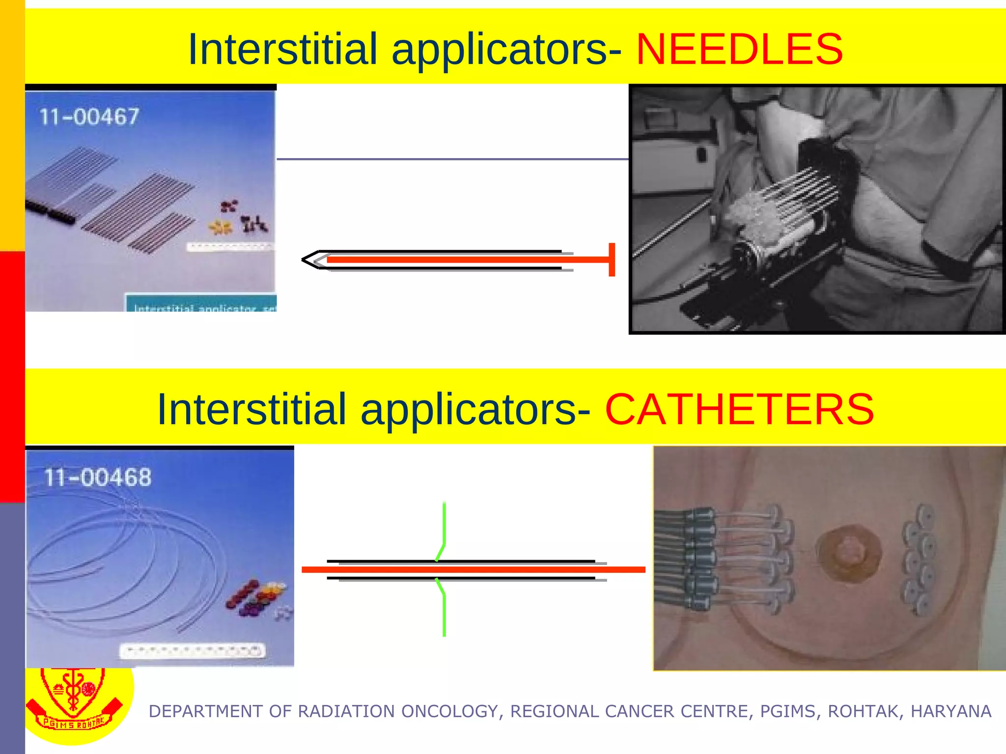Interstitial Radiotherapy physics and clinical aspects of interstitial brachytherapy | PPT