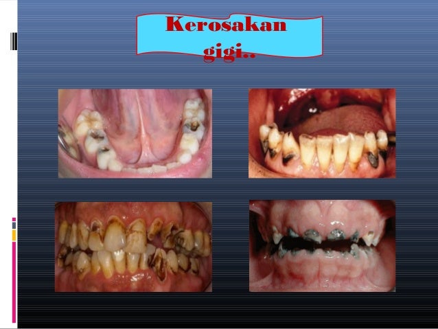 Ibu mengandung dan kesihatan pergigian