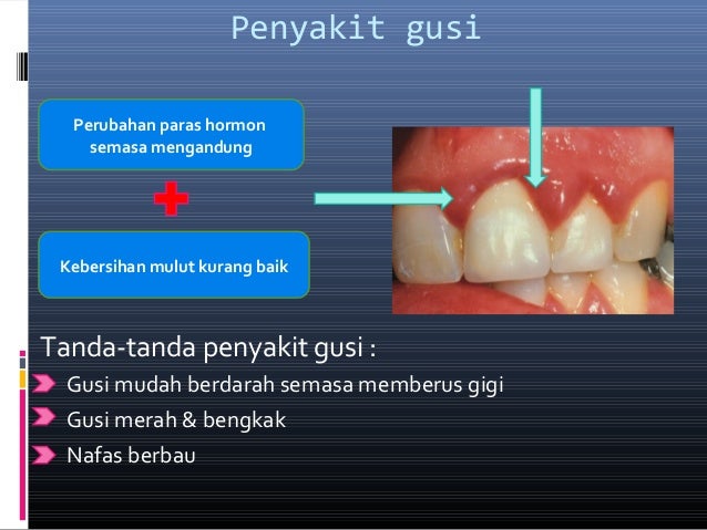 Ibu mengandung dan kesihatan pergigian