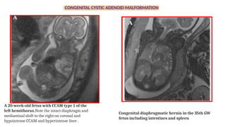 ic- congenital diaphragmatic hernia.pptx
