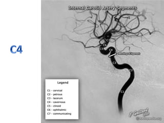 ICA anatomy | PPTX