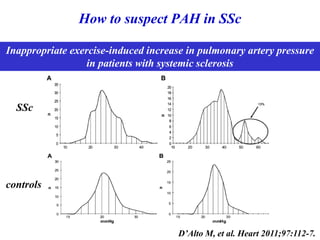 How to suspect PAH in SSc
D’Alto M, et al. Heart 2011;97:112-7.
Inappropriate exercise-induced increase in pulmonary artery pressure
in patients with systemic sclerosis
controls
SSc
 