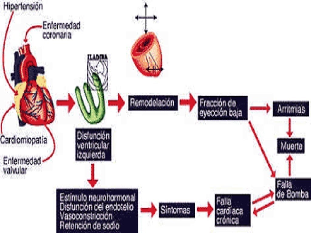 Insuficiencia Cardiaca Congestiva