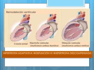 Remodelación ventricular

Corazón normal

Hipertrofia ventricular
(insuficiencia cardiaca diastólica)

Dilatación ventricular
(insuficiencia cardiaca sistólica)

HIPERTROFIA ADAPTATIVA DISFUNCIÓN VI HIPERTROFIA DESCOMPENSADA

 