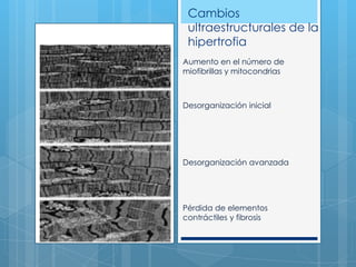 Cambios
ultraestructurales de la
hipertrofia
Aumento en el número de
miofibrillas y mitocondrias

Desorganización inicial

Desorganización avanzada

Pérdida de elementos
contráctiles y fibrosis

 