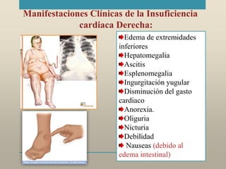 Manifestaciones Clínicas de la Insuficiencia
cardiaca Derecha:
Edema de extremidades
inferiores
Hepatomegalia
Ascitis
Esplenomegalia
Ingurgitación yugular
Disminución del gasto
cardiaco
Anorexia.
Oliguria
Nicturia
Debilidad
Nauseas (debido al
edema intestinal)
 