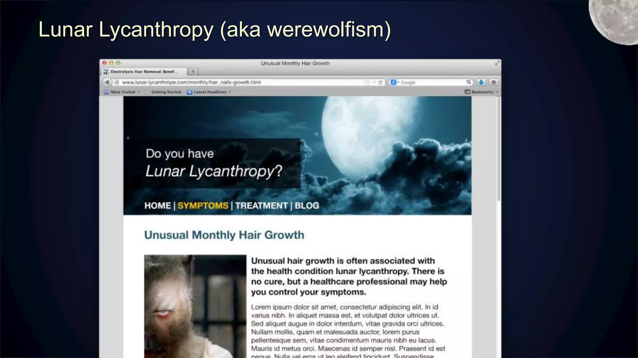 Lunar Lycanthropy (aka werewolfism) M
 