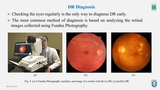 5
DR Diagnosis
Fig. 5: (a) A Fundus Photography machine, and image of a retinal with (b) no DR, (c) prolific DR
 Checking the eyes regularly is the only way to diagnose DR early.
 The most common method of diagnosis is based on analyzing the retinal
images collected using Fundus Photography.
(a) (b) (c)
Dec 20, 2019
 