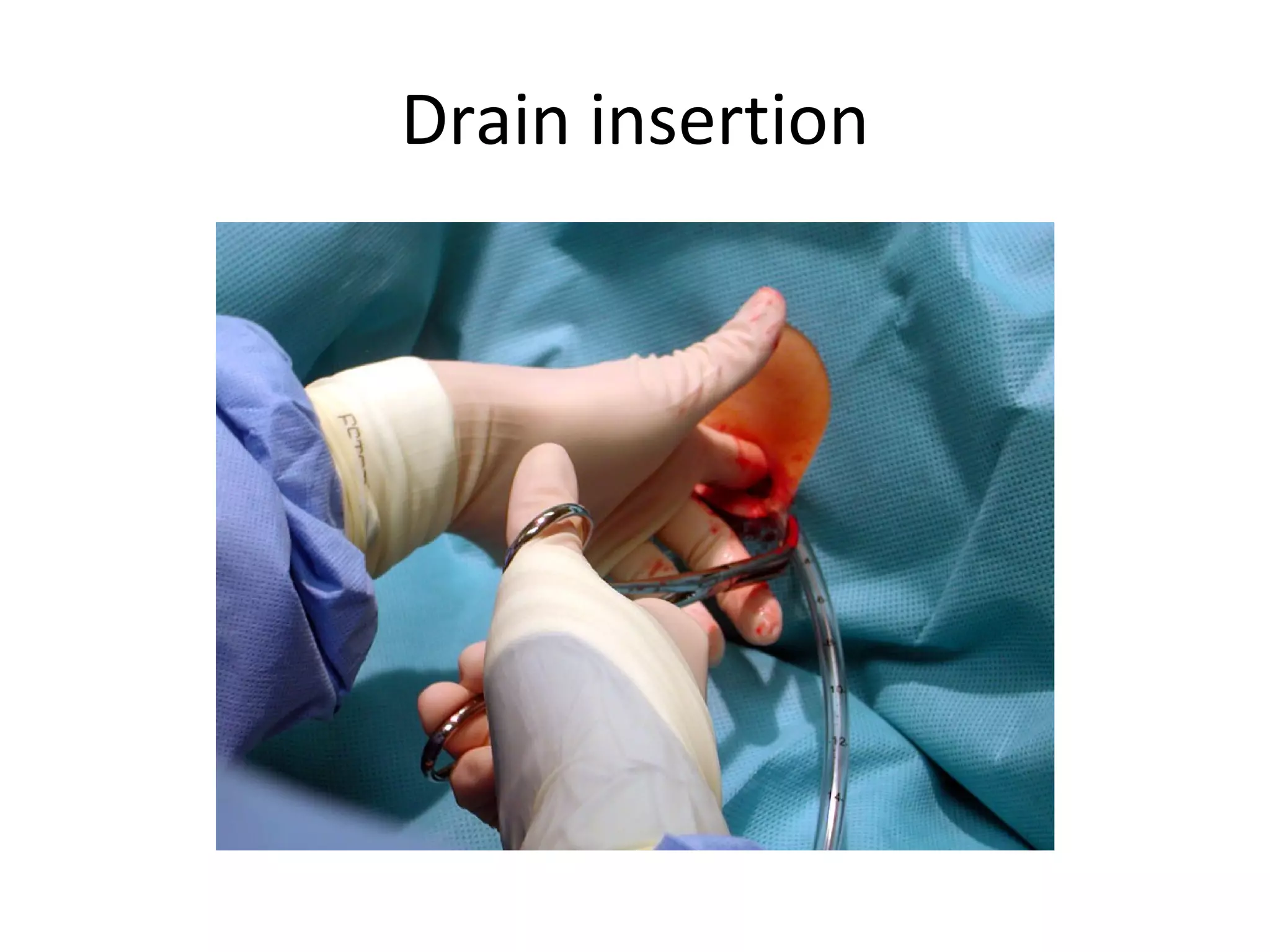Drain insertion 