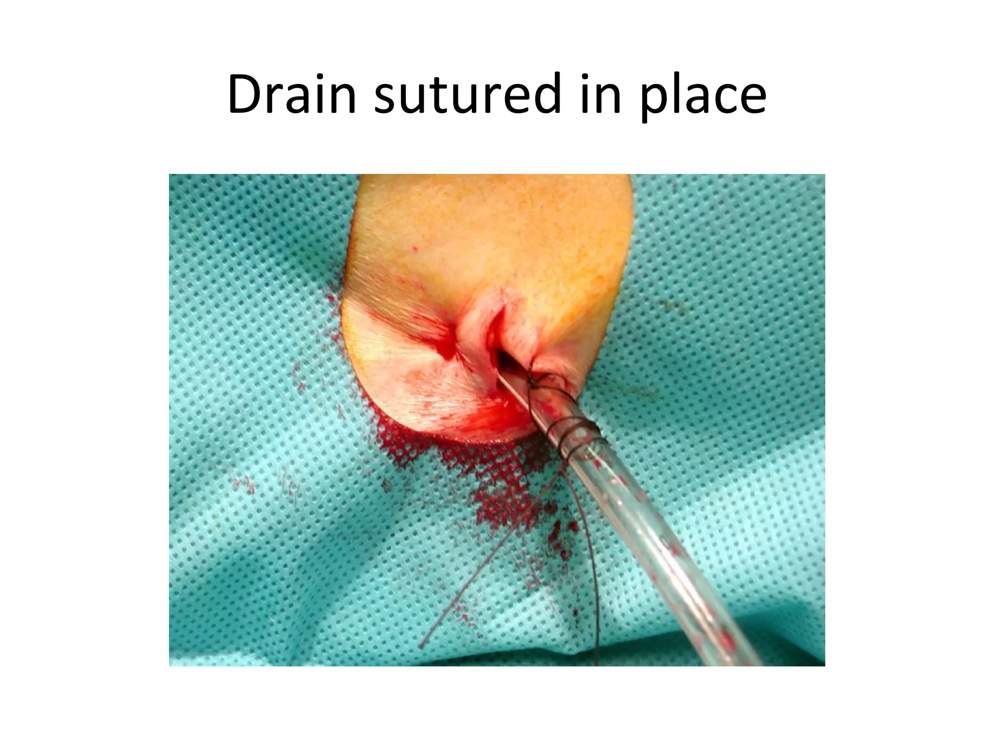 Drain sutured in place 