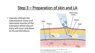 Step 3 – Preparation of skin and LA
• Liberally infiltrate the
subcutaneous tissue and
intercostal muscles of the
interspace where pleural
entry will occur and down
to the parietal pleura.
 