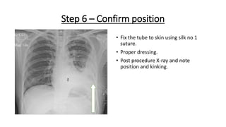 Step 6 – Confirm position
• Fix the tube to skin using silk no 1
suture.
• Proper dressing.
• Post procedure X-ray and note
position and kinking.
 