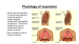 Physiology of respiration
• At the time of respiration
in normal lung, pressure
in pleural spaces is
always negative
compared to atmosphere
air pressure.  So it has
tendency to suck air
inside when there is
breach in barrier.
• ICD is iatrogenic case of
breach in barrier.
 