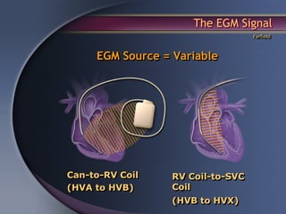 Basic Egm Signals Icd basic 042411(dr chang) | PDF