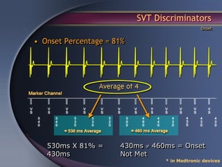 SVT Discriminators
                                               Onset


• Onset Percentage = 81%




   530ms X 81% =      430ms ≠ 460ms = Onset
   430ms              Not Met
                                 * in Medtronic devices
 